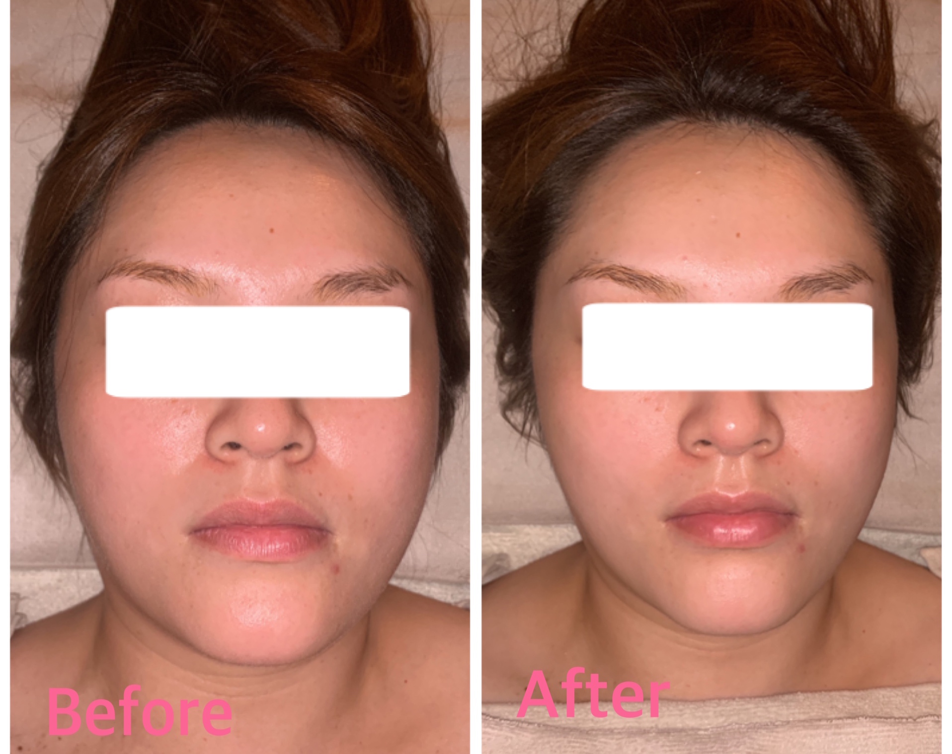 ハーブピーリング　エステ　美白　ニキビ対策　黒ずみ対策　フェイシャル　美白 ハーブピーリング エステ 美白 ニキビ対策 黒ずみ対策